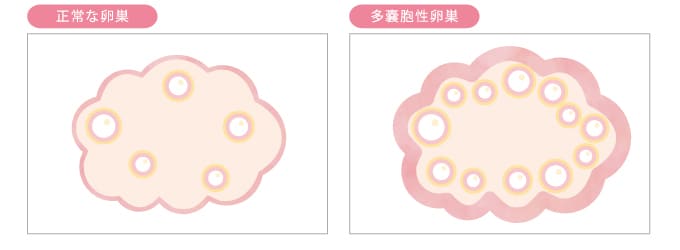 子宮内膜症と PCOS の原因は何ですか?