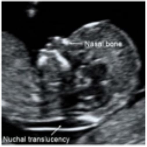 オスカー検査（初期胎児ドッグ）の画像