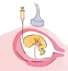 羊水検査の画像