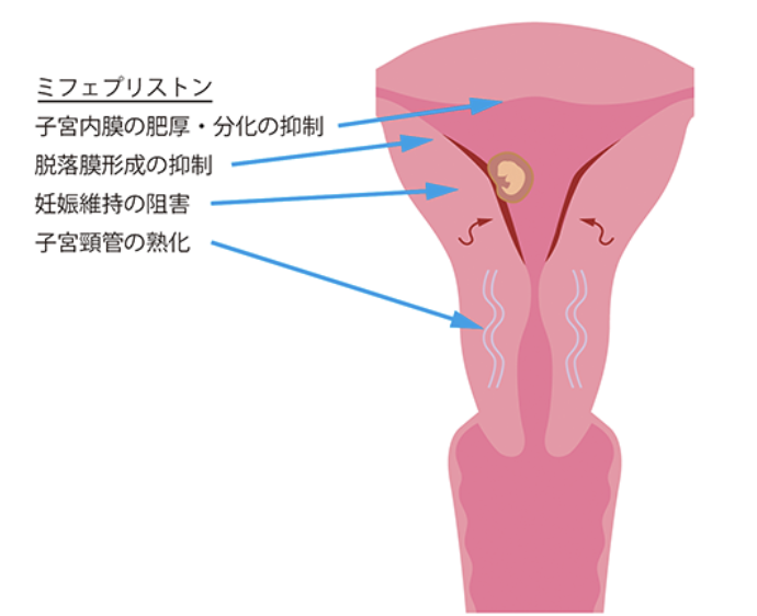 メフィーゴパックの診察・薬服用