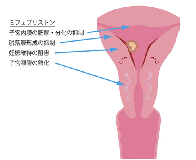 メフィーゴパックの診察・薬服用